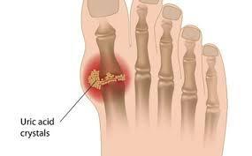 GOUT caused by a buildup of uric acid crystals in the joints Uric acid is normally found