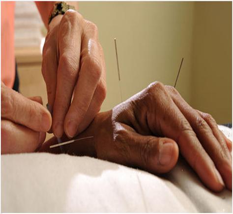 Acupuncture Acupuncture can trigger the body to release the