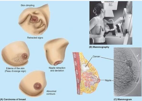 Digital mammograms replacing conventional film mammography younger women with dense breast tissue benefit most from this type of mammography.