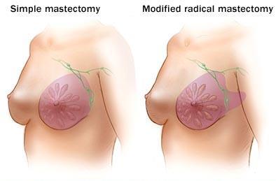 breast excision simple mastectomy breast is removed down to the retromammary space.