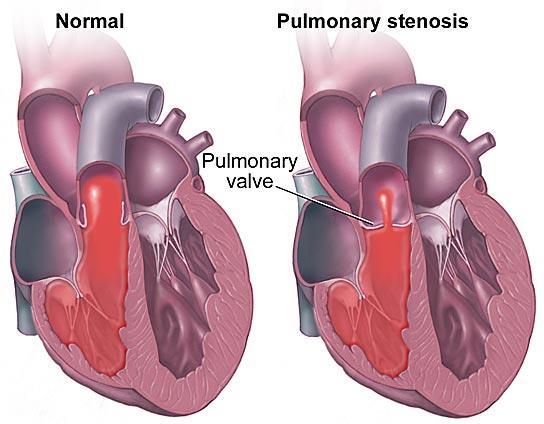 Narrowing of the pulmonary valve due to the fused cusps.
