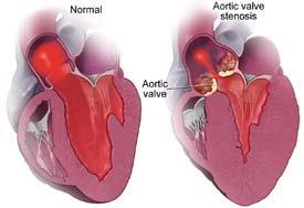 most frequent valve abnormality Blood is unable to flow freely from left ventricle to aorta.