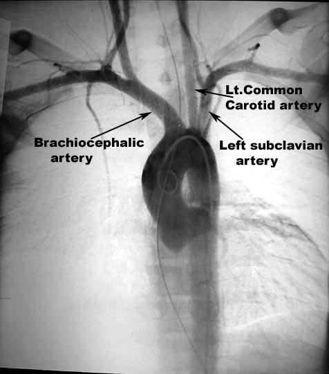 ligamentum arteriosum remnant of the