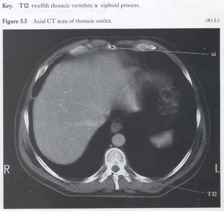 Inferior Thoracic Aperture this is liver not lung because the section is at level of T12 and because of the dome within the