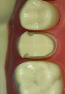 movement, this continue until contact with adjacent tooth is broken & access for