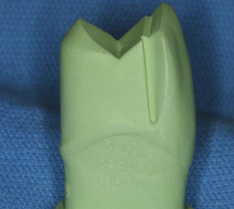 were used on proximofacial & occlusofacial margins Mandibular 3/4 Crown Differences between upper &lower posterior ¾ crown
