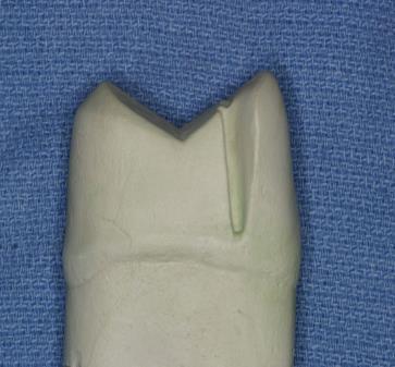 Proximal reduction: The area is prepared similar to the full veneer crown except that the