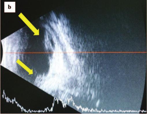 Original Article Fig. 4: Ultrasonographic findings observed in advanced ROP.