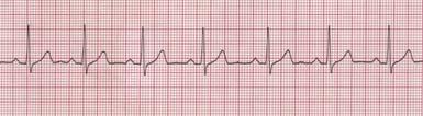 Waves & Intervals P wave Atrial depolarization (right then left) Usually upright (positive) PR interval 0.12-0.