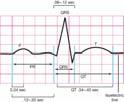 always present, R first positive, S negative after R Ventricular depolarization < 0.10-0.