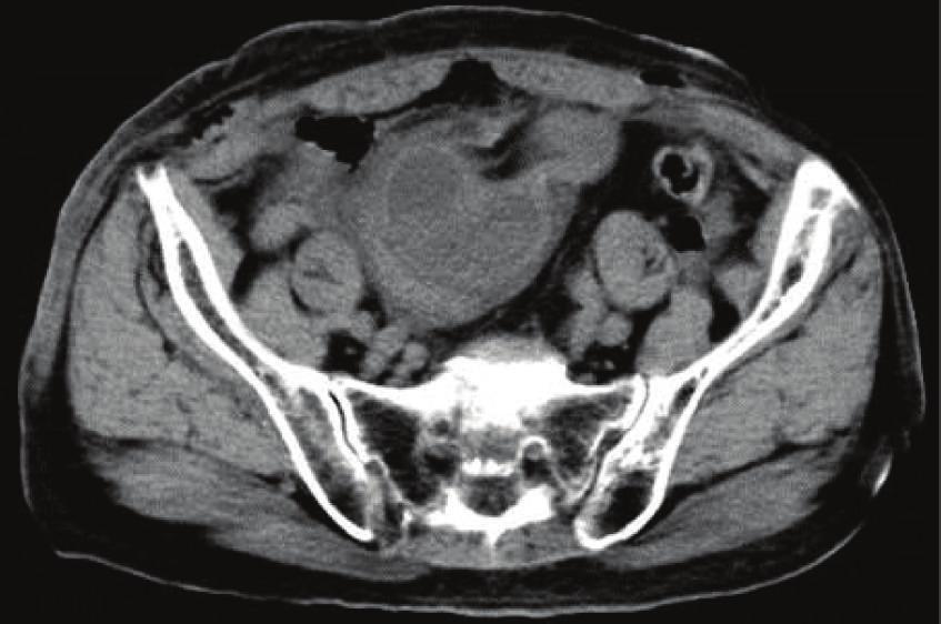 Case Reports in Surgery 3 (a) (b) Figure 2: (a) A cyst-like bowel loop is visible in the pelvic cavity.
