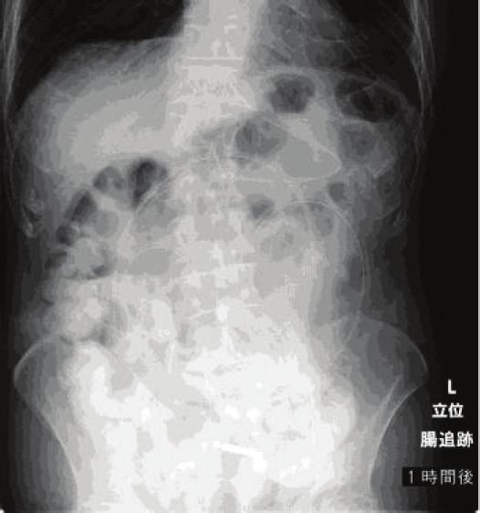 (b) Abdominal X-ray image 1 hour after injection of contrast agent from the ileus tube. Contrast agent has reached the colon, the small bowel is not dilated, and bowel obstruction has improved.
