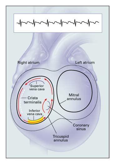Typical Atrial fibrillation may later occur as Counterclockwise; underlying substrate similar Reverse typical Clockwise Anticoagulation essential