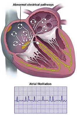 Atrial Fibrillation Mechanism Rapidly discharging foci that originate in pulmonary veins