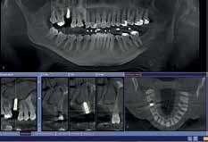 In particular, it is much easier to position the patient. 1 Postoperative half-view exposure with normal implant position.
