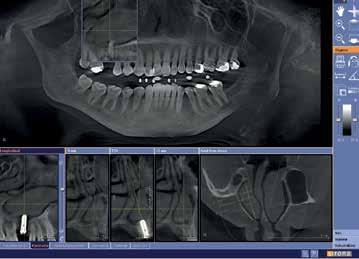 The complete case study in German was published in: Scheifele C, 3D-Röntgen nach Implantat-Komplikationen. Dental Magazin, 5/2007.