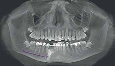 3D image identifies odontoma author Dr. Fred Bergmann, Viernheim (Germany) A male patient presents a displaced tooth in region 43.