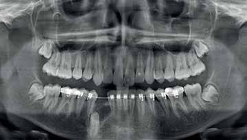 Displaced tooth 43 was then exposed vestibularly and inserted orthodontically. The odontoma was also removed lingually.