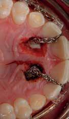 Spontaneous penetration does not always occur in such cases when the deciduous teeth are removed.