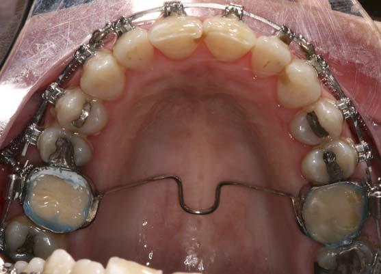 Intrusive forces in the molar region should be light and continuous to produce the appropriate pressure within the periodontal ligament and minimize the risk of root resorption.