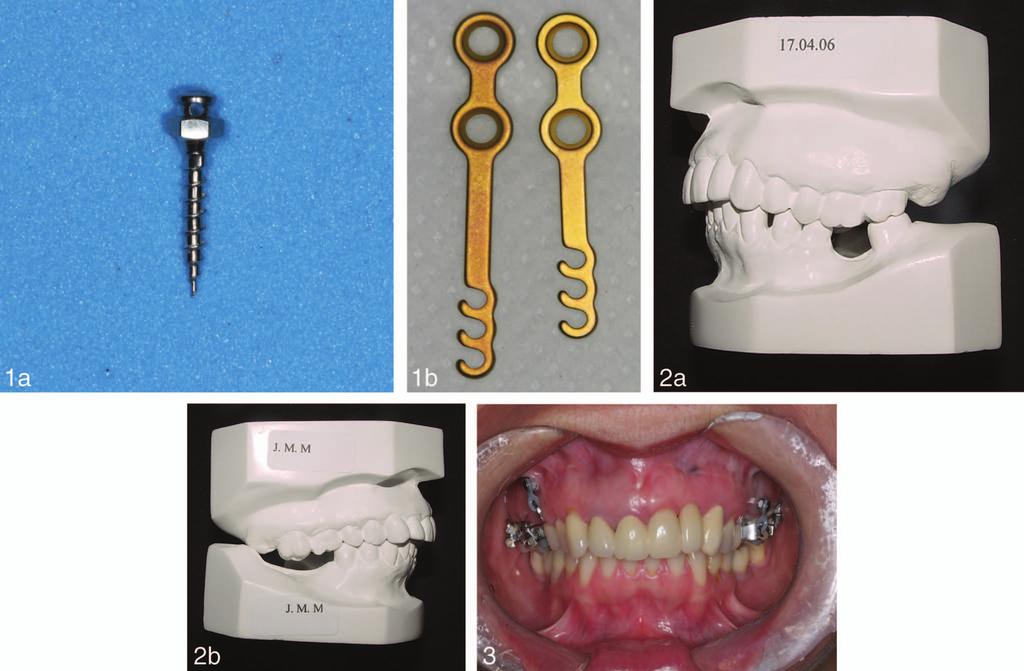 Faot et al FIGURES 1 3. FIGURE 1. Anchorage systems. (a) Mini-implant. (b) Mini-plates. FIGURE 2. Model analysis. (a) Right side. (b) Left side. FIGURE 3.