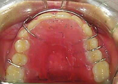 4) [Pinkham, 2010]. Case 4 PJ was a 42-year-old female who sought orthodontic treatment for lower anterior crowding resulting in severe incisal attrition due to zero overjet.