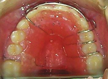 A removable appliance, rather than a fixed treatment, was delivered to the patient to resolve the lower anterior crowding, moving the lower central incisors lingually and the lateral incisors