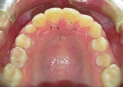 Maxillary canines are the last teeth to erupt in the upper jaw, and therefore they often face space shortage, resulting in impaction which requires additional treatment procedures with multiple