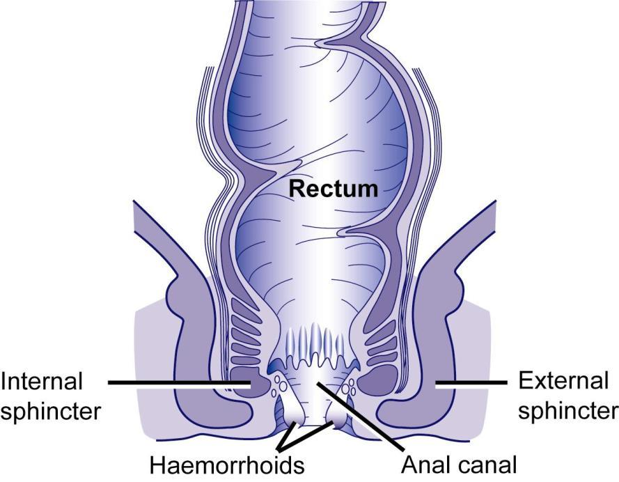 Haemorrhoid Operation What are haemorrhoids? Everyone has swellings in the anal canal (back passage) called anal cushions.