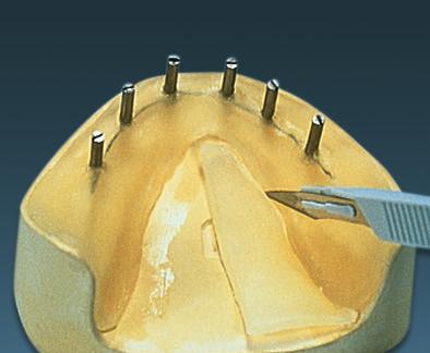 Because precision is crucial when gauging bone depth and implant