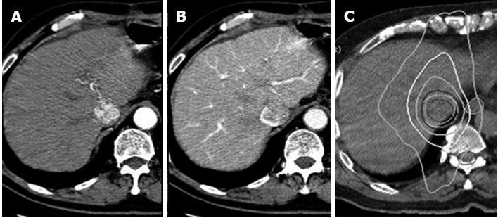 Hepatocellular carcinoma case that could not be effectively or safely treated with any treatment except for stereotactic body radiation therapy.