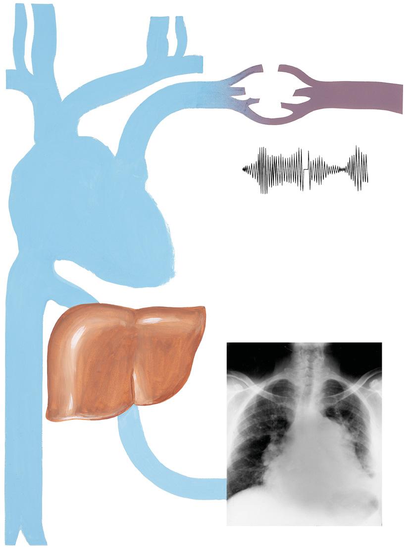 Figure 31-1 Tricuspid Stenosis and/or Insufficiency Engorged, pulsating neck veins (presystolic in stenosis, systolic in insufficiency) Cogwheel respiration in insufficiency Pulmonary congestion of