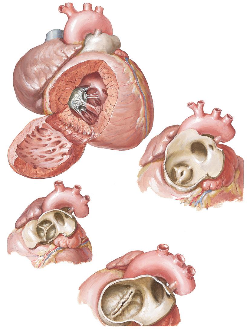 Figure 31-3 Pulmonary Valvular Stenosis and Atresia Pulmonary valvular stenosis with intact septum: Hypertrophy of right ventricle Stenotic