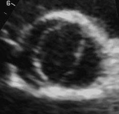 Bicuspid Aortic Valve Most common congenital