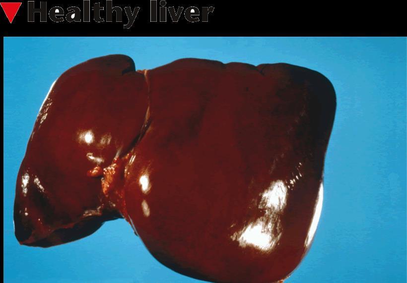 Liver Damage Alcohol interferes with the liver s ability to