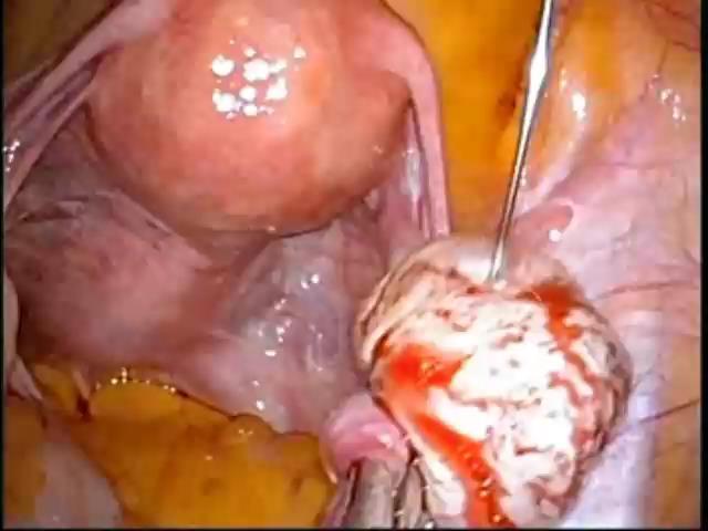 Ovariectomy by Single port