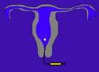 hcg Ovarian Stimulation - regimens FSH = follicle stimulating hormone GnRHa = gonadotrophin releasing hormone antagonist hcg =