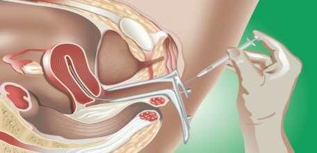 Intrauterine insemination (IUI) often the first step in