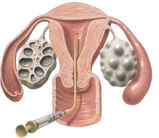 Embryo transfer precise placement of the embryo inside the uterus is important touching the fundus may cause the uterus to contract and harm chances of implantation if the catheter is not inserted