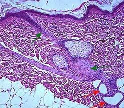 into dermis Apocrine sweat gland What to look for: Associated
