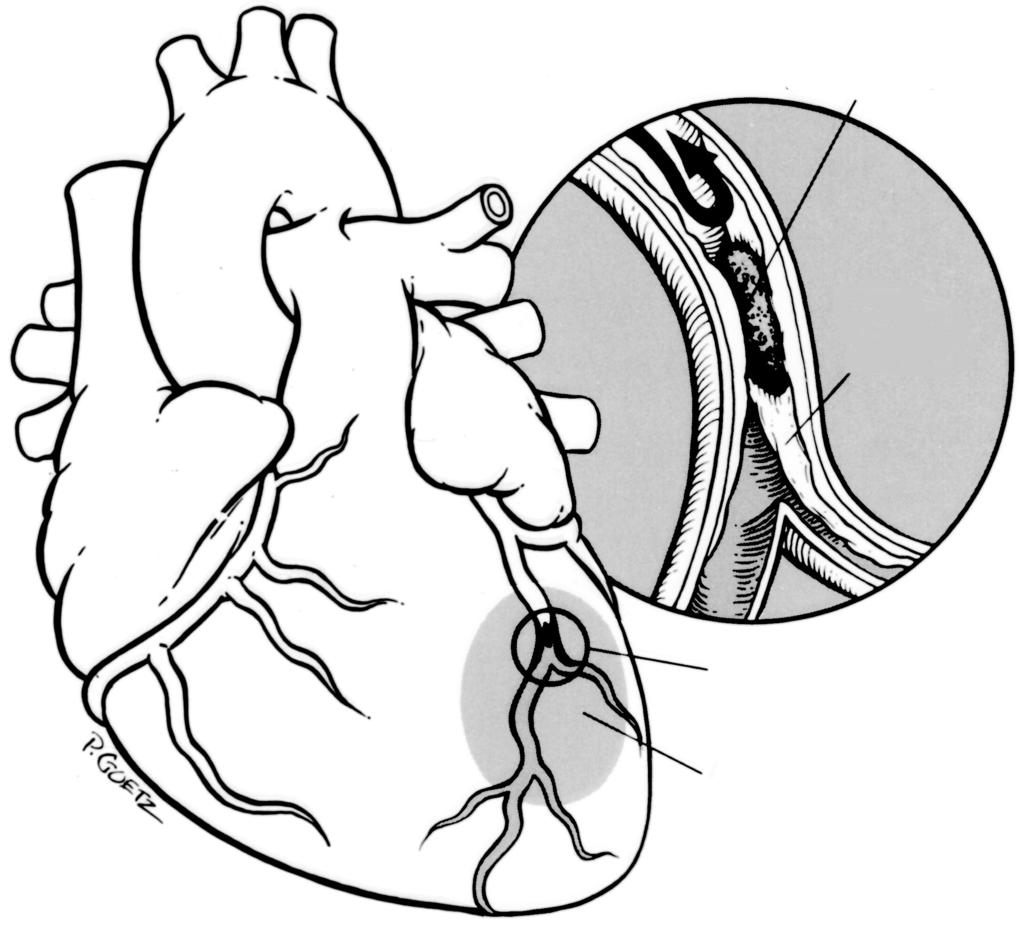 HEART FUNCTION, DISEASE AND TREATMENT A5 Heart Attack Clot preventing blood flow Plaque buildup Site of blockage in coronary artery Affected area of the heart nausea vomiting Is usually not relieved