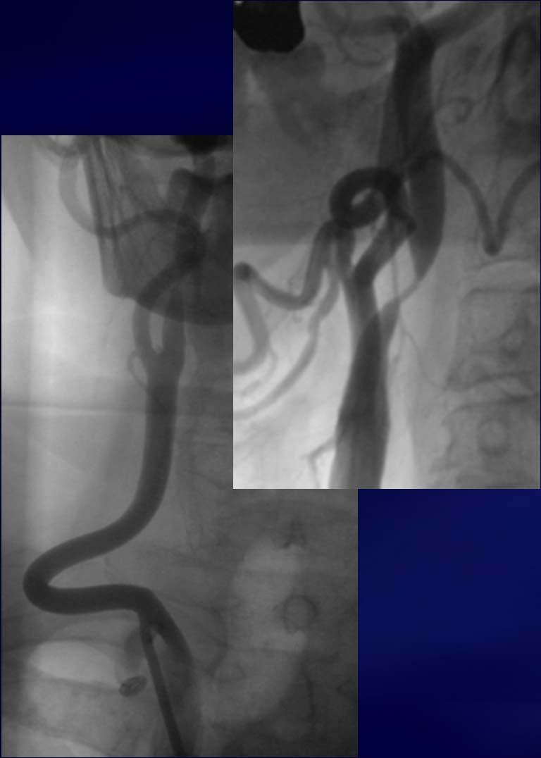 Case 2: High grade soft lesion - CCA proximal bend - Endovascular strategy 1. Secure engagement of guiding catheter in right CCA (buddy wire technique) 2.