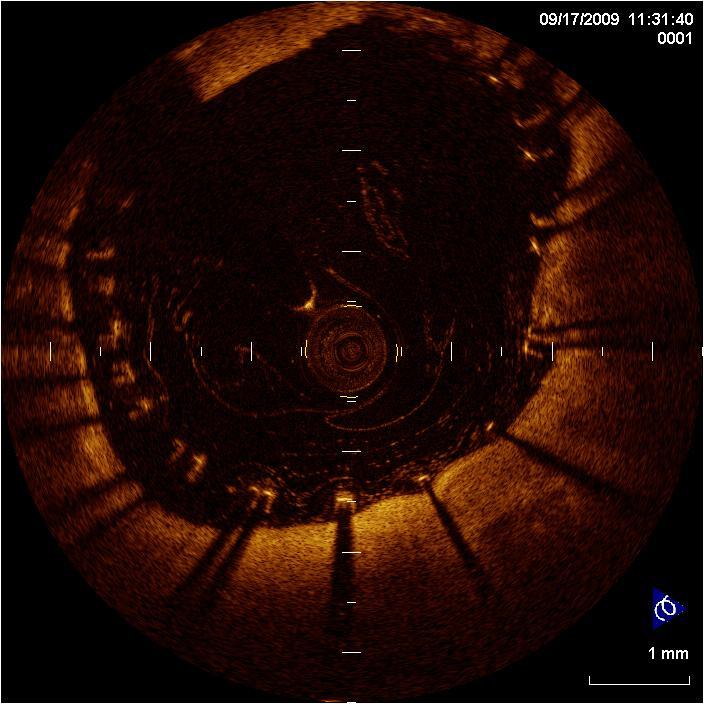 Optical coherence tomography OCT