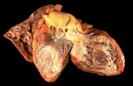 coronary arteries Leads to death of cardiac cells in