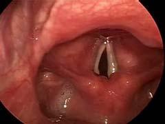 Vocal Cord Paresis Post Lung Transplantation
