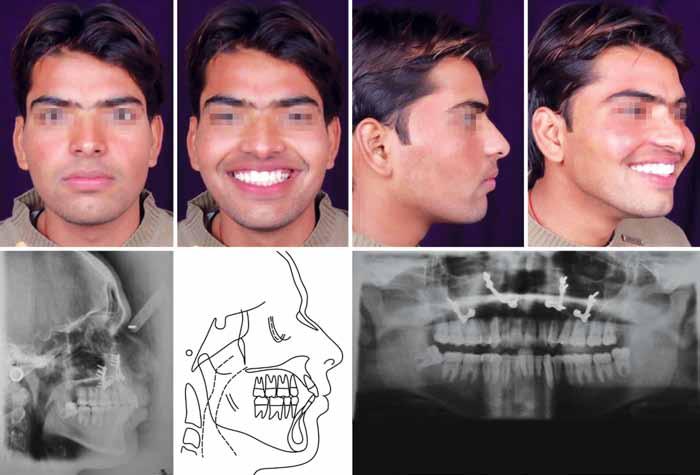JIOS Surgical-Orthodontic Treatment of Gummy Smile with Vertical Maxillary Excess Fig. 7A: Post-treatment records Fig.