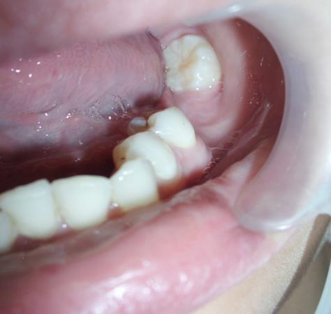 , 16 years old) with right first permanent molar lost Fig. 7. Modified occlusal view of dental arches (patient M.N.
