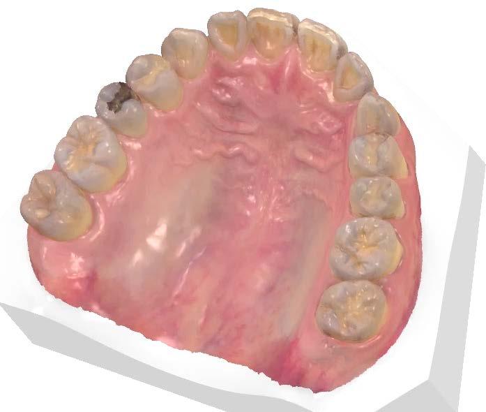 Sufficient Soft Tissue Extension Sufficient palatal soft