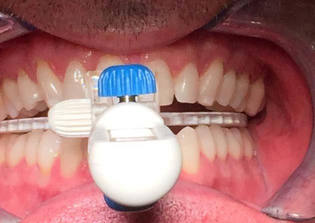 If a distal wrap of last tooth requested a complete coverage of last