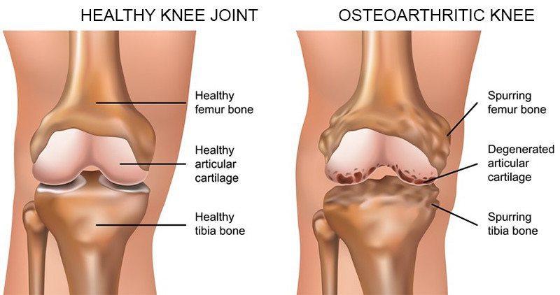 Figure 3: Healthy Knee vs OA knee with bone spurs (Website #4) Osteoarthritis (OA) may sometimes be called degenerative joint disease or degenerative arthritis.